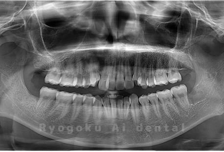 上下顎左右の4本の親知らずの抜歯
