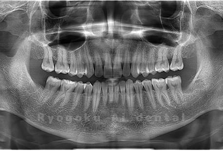 下顎左右の2本の親知らずの抜歯