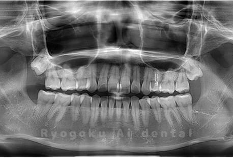 下顎左右の2本の親知らずの抜歯