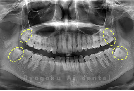 上下顎左右の親知らず