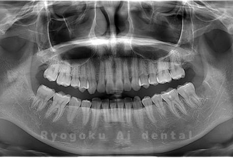 上下顎左右の4本の親知らずの抜歯