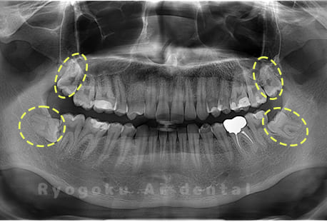上下顎左右の親知らず