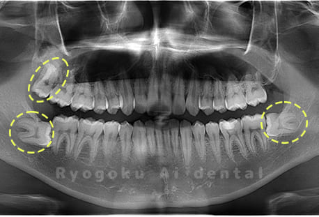 上顎右1本、下顎左1本、下顎右1本の親知らず