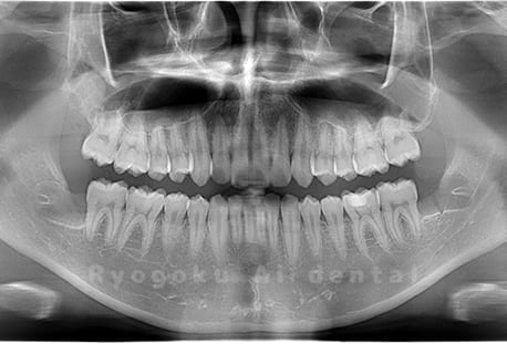 上顎右1本、下顎左1本、下顎右1本の親知らずの抜歯