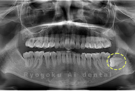 下顎左の親知らず