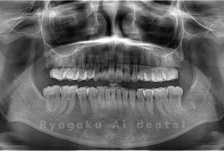 下顎左の1本の親知らずの抜歯