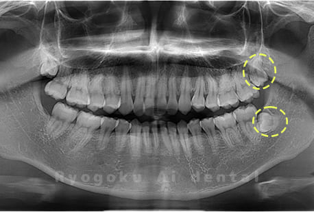 上下顎左の親知らず