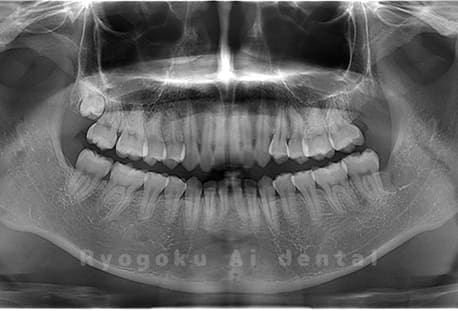 上下顎左の2本の親知らずの抜歯