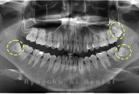 上顎左1本、下顎左右2本の親知らず