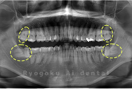 上顎左右2本、下顎左右2本の親知らず