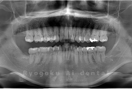 上顎左右2本、下顎左右2本の親知らずの抜歯