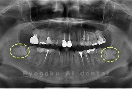 下顎左右2本の親知らず