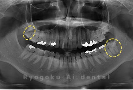 上顎右、下顎左の親知らず