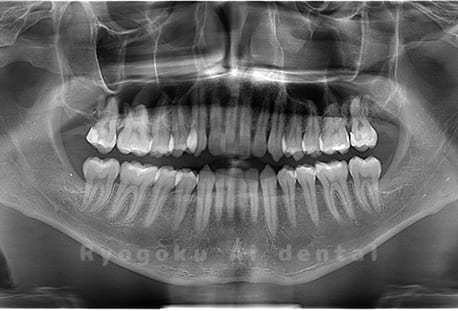 上顎2本、下顎2本の親知らずを抜歯