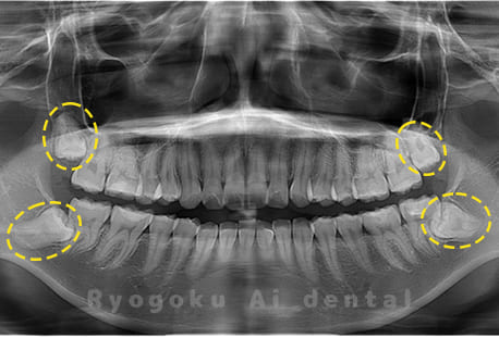 上下顎右左の親知らず
