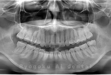 上顎2本、下顎2本の親知らずを抜歯
