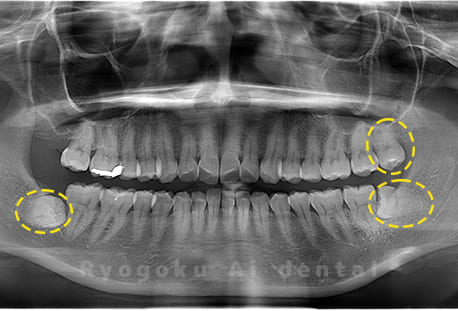 上顎左、下顎右左の親知らず