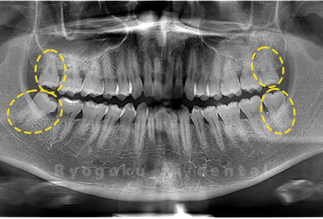 上下顎右左の親知らず