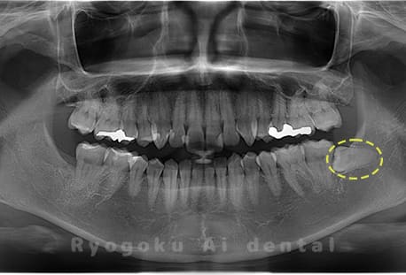 下顎左の親知らず