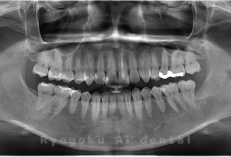 下顎左の親知らずの親知らずを抜歯