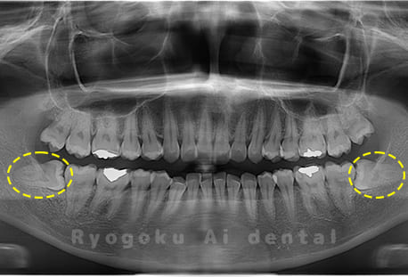 下顎左右の親知らず