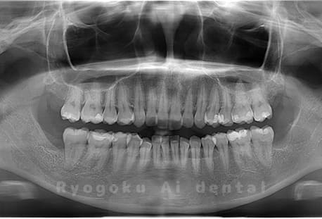 下顎左右の親知らずの親知らずを抜歯