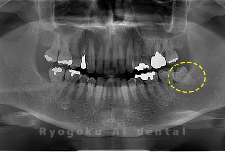 下顎左の親知らず