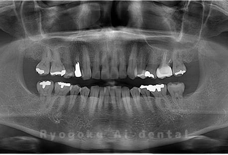 下顎左の親知らずの親知らずを抜歯