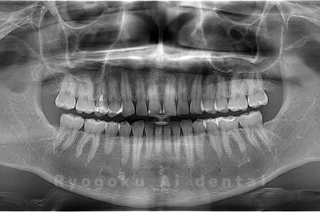 下顎左右の親知らずの親知らずを抜歯