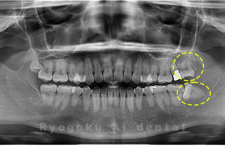 上下顎左の親知らず