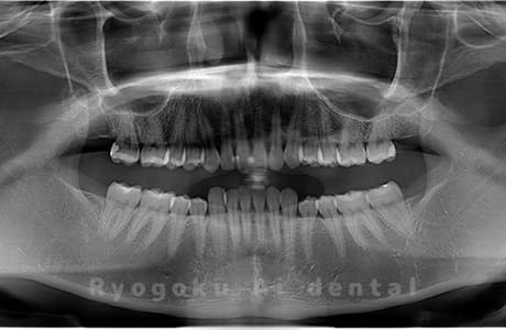 上下顎左右の親知らずの親知らずを抜歯