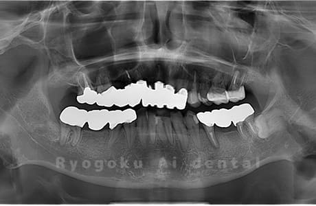 下顎右の親知らずの親知らずを抜歯