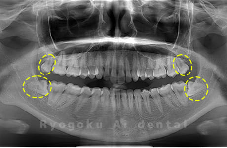 上下顎左右の親知らず