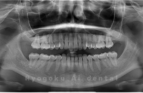 上下顎左右の親知らずの親知らずを抜歯