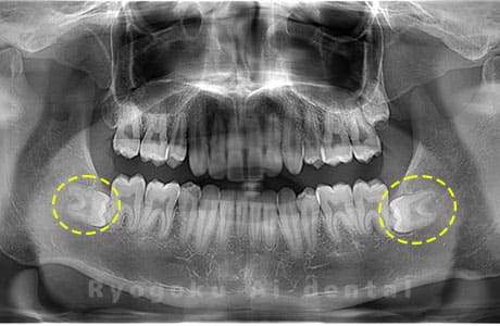 下顎左右の親知らず