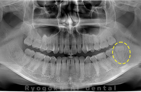 下顎左の親知らず
