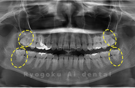 上下顎左右の親知らず