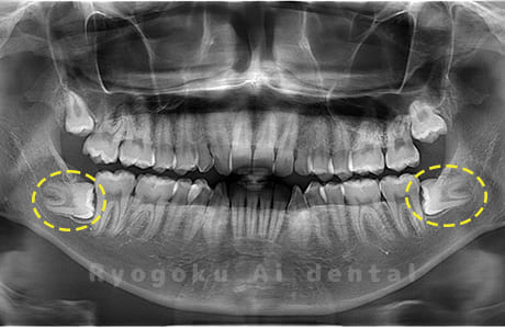 下顎左右の親知らず