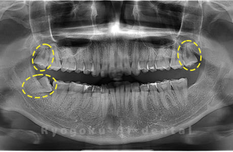 上顎左右、下顎右の親知らず