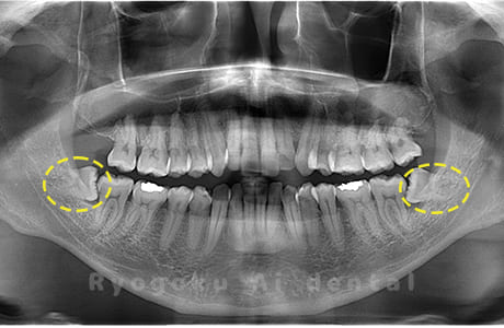 下顎左右の親知らず