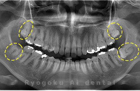 上下顎左右の親知らず