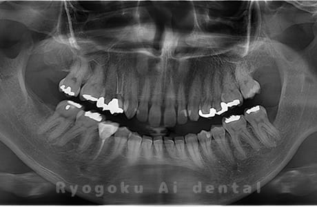 上下顎左右の親知らずを抜歯