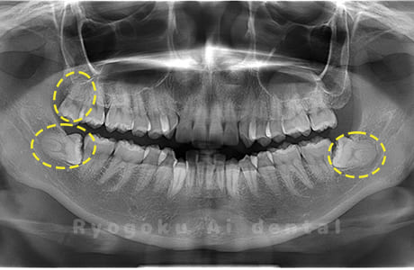 上顎右、下顎左右の親知らず