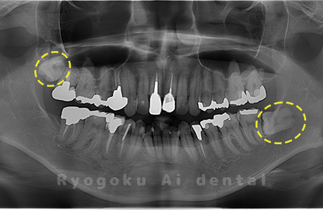 上顎右、下顎左の親知らず