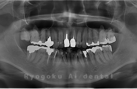 上顎右、下顎左の親知らずを抜歯