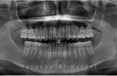 上顎右、下顎左右の親知らずを抜歯