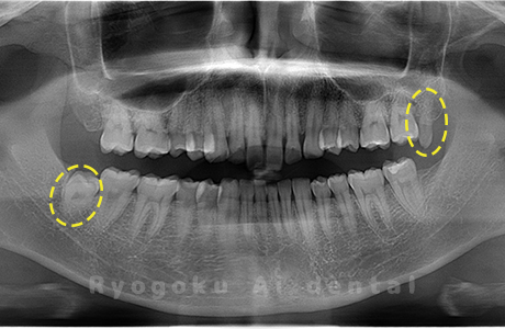 上顎左、下顎右の親知らず