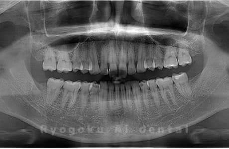 上顎左、下顎右の親知らずを抜歯