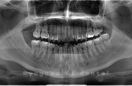下顎右の親知らずを抜歯