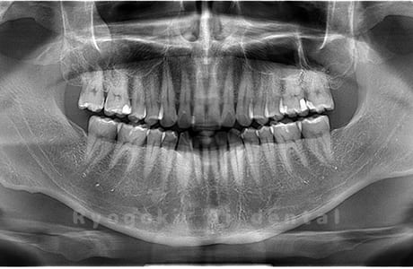 上顎左の親知らずを抜歯